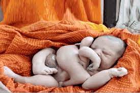 Photo of कटिहार सदर अस्पताल में जन्मा चार हाथ-चार पैर वाला बच्चा